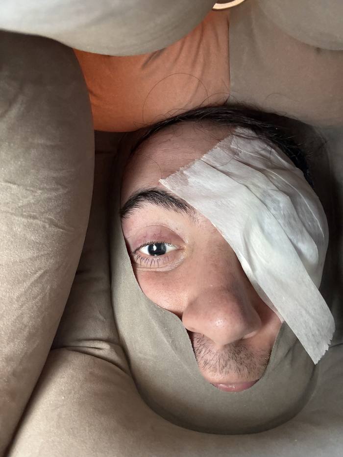 Tyler resting at home with a protective patch over his left eye after surgery.
