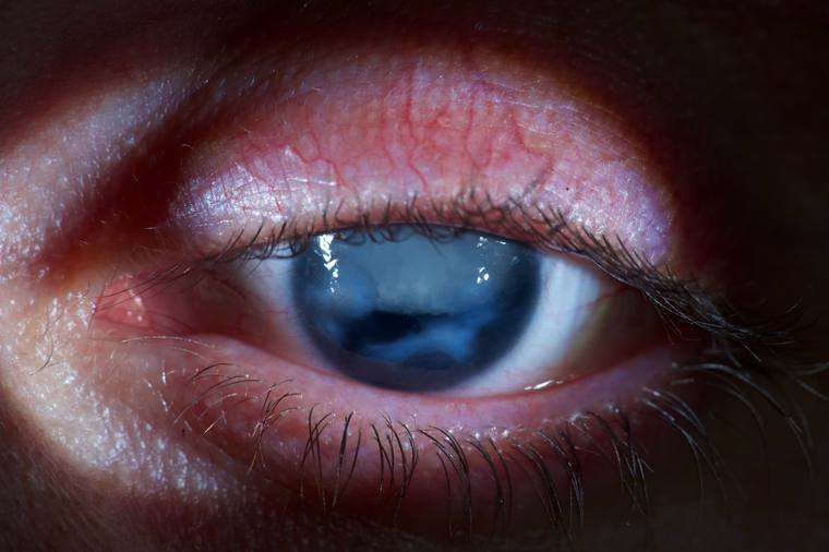 Extreme close-up of Tyler's eye before surgery, showing the cloudy blue surface of aniridia.