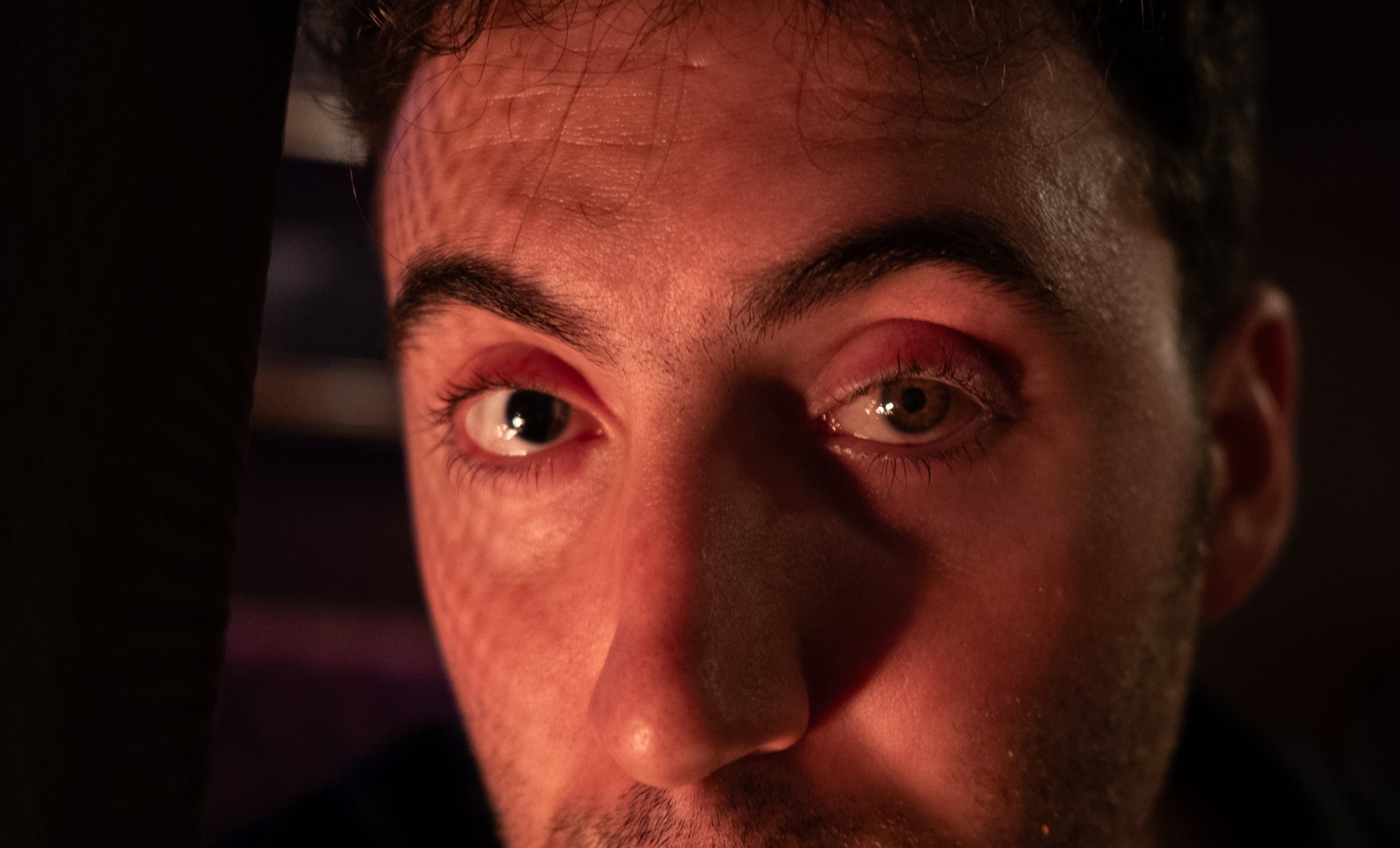 Extreme close-up of Tyler Gibgot's face in warm light, both eyes meeting the camera, one pupil fully dark from aniridia and one hazel.