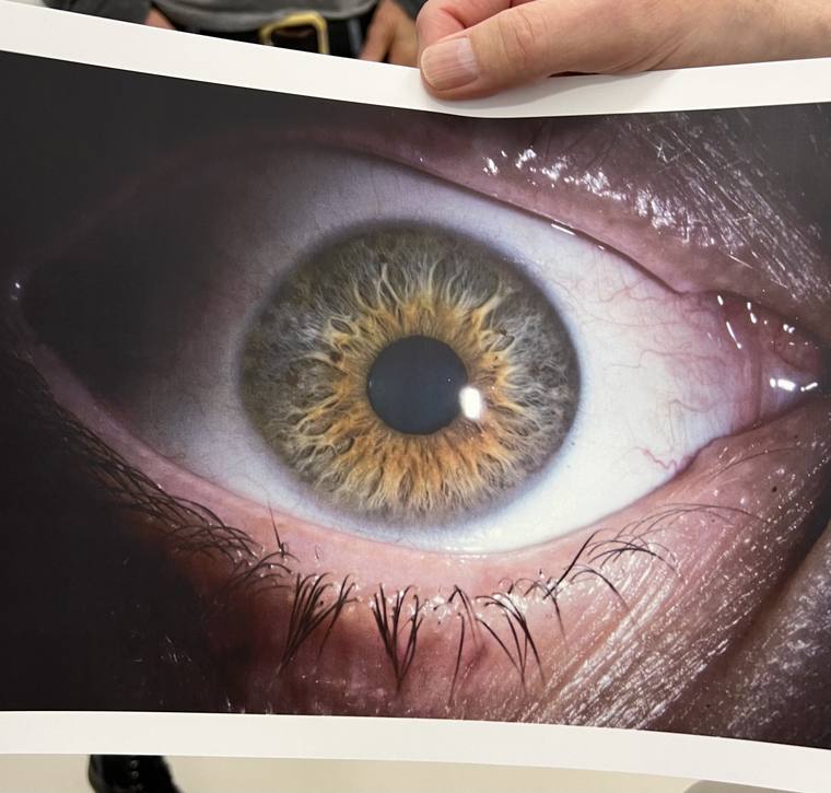 A hand holding a large printed photo of Tyler's eye with its new artificial iris.
